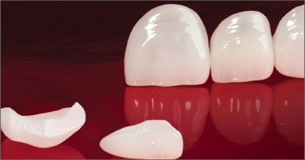 Quy trình dán răng sứ Veneer tại Nha Khoa Quốc Tế K-Da