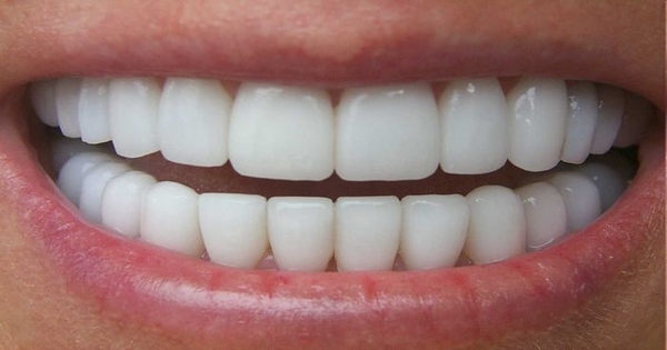Những lợi ích tuyệt vời mà bọc răng sứ thẩm mỹ mang lại