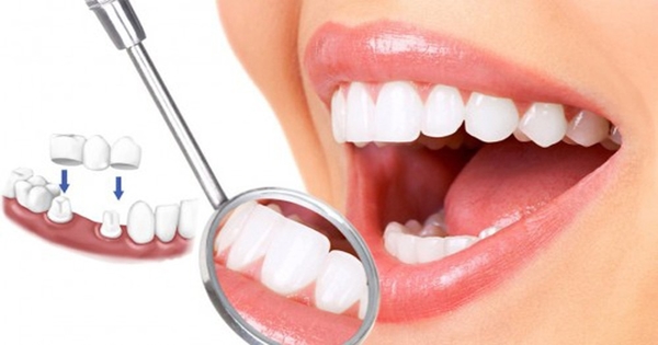 Răng sâu có nên bọc răng sứ hay không?