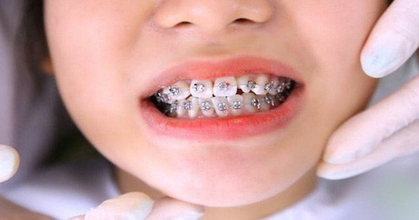 Phương pháp niềng răng là gì? Có đau không?