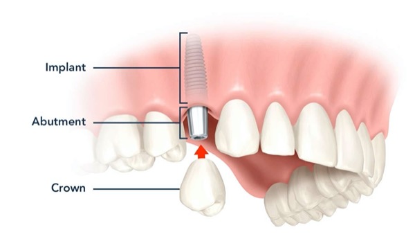 Cấu tạo trụ Implant
