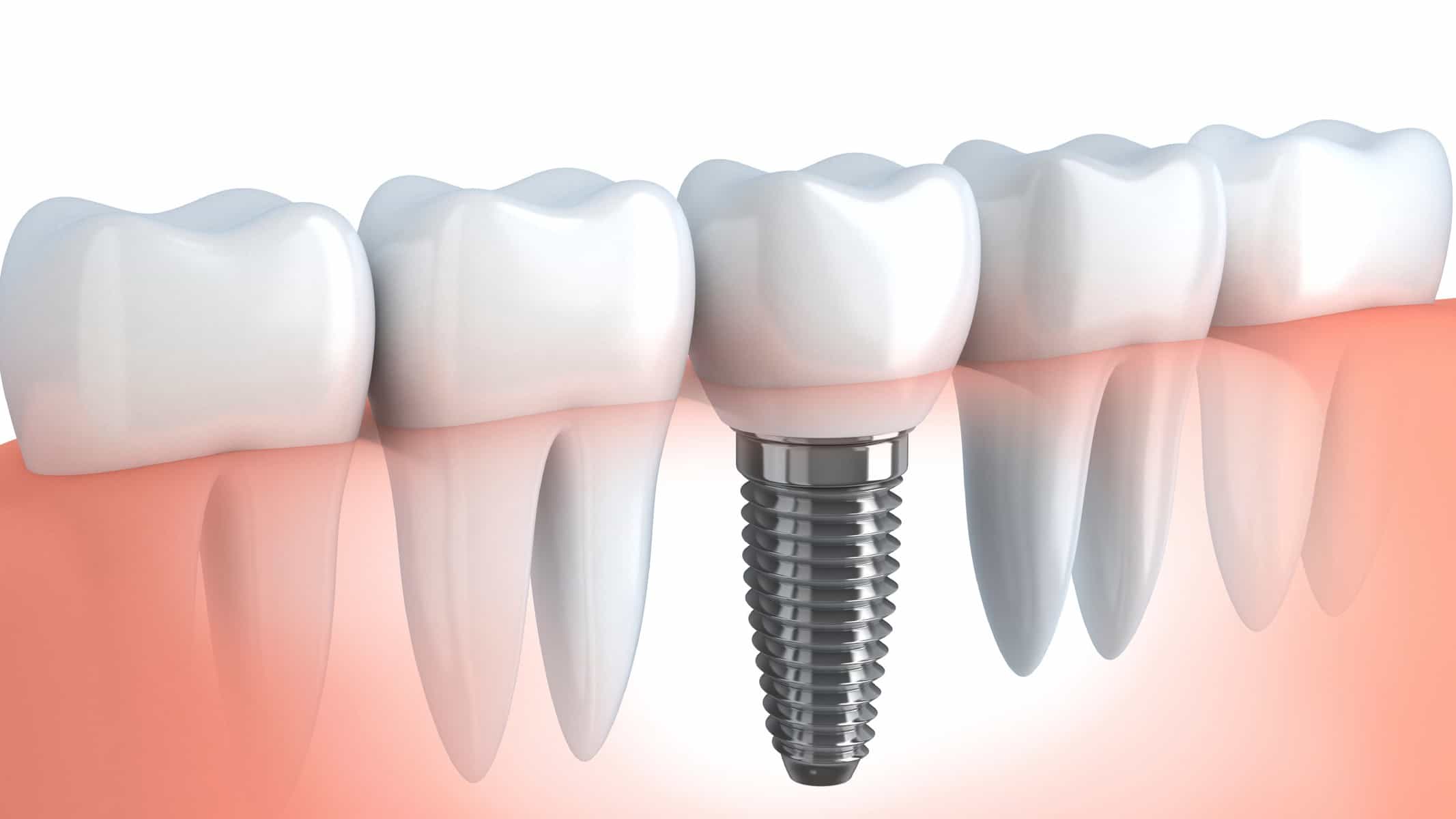 Implants