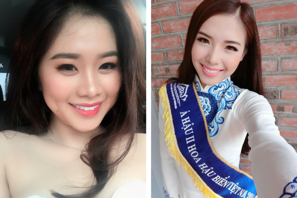 Implant tại nha khoa K-Da
