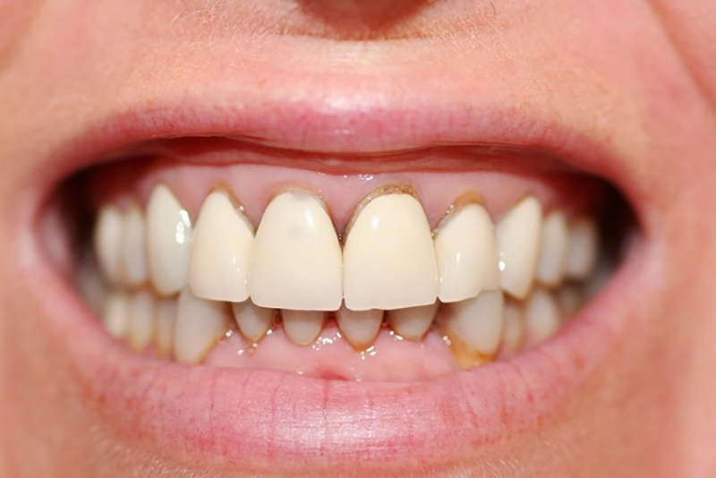 Mặt dán sứ Veneer – Công nghệ bảo tồn răng thật